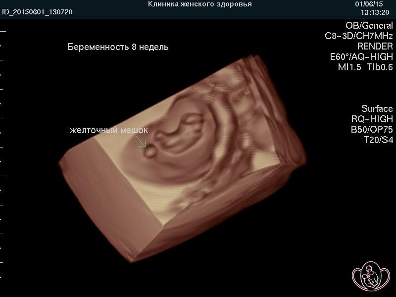 3D-фото беременности 8 недель