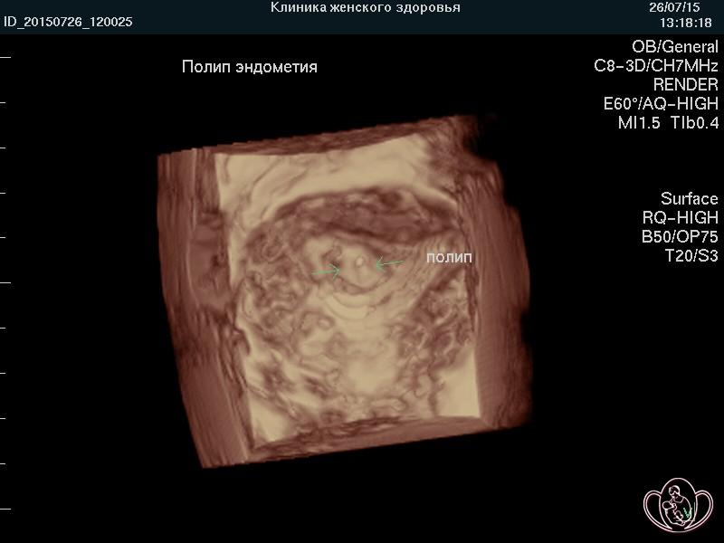 3D-фото полипа эндометрия. Полип определяется в дне матки