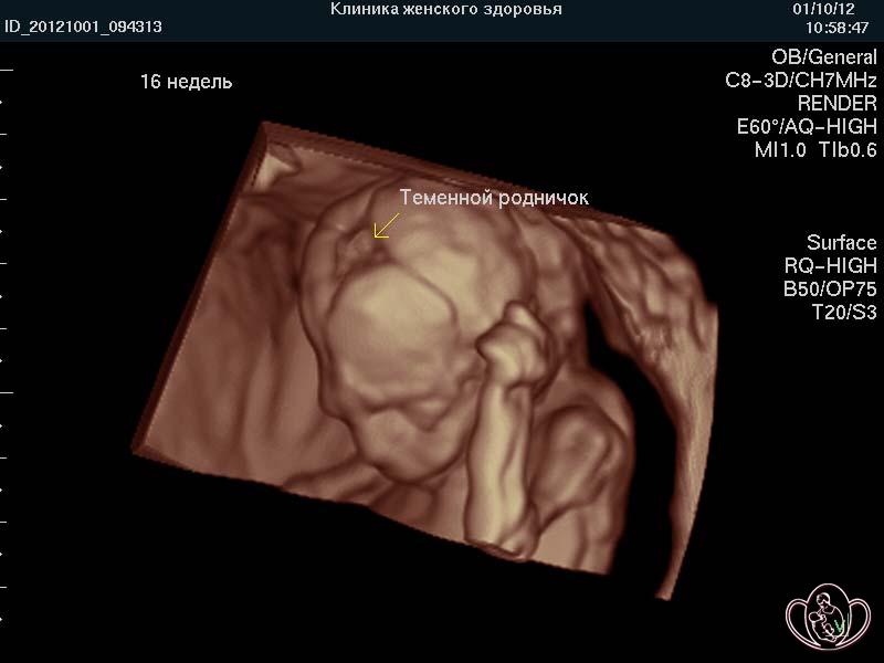 3D-реконструкция головы плода 16 недель беременности