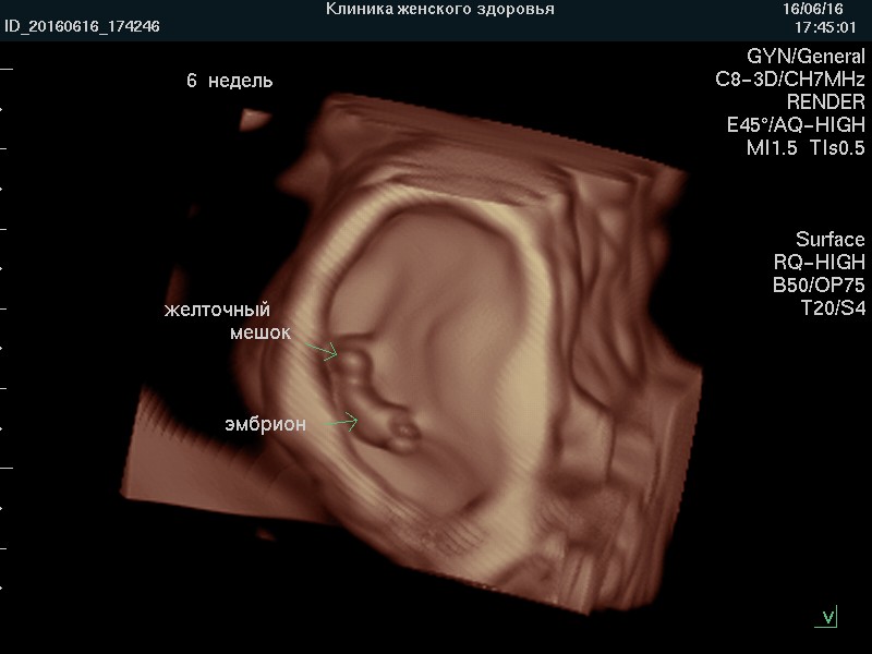 3д фото беременности 6 недель после лечения в нашей Клинике