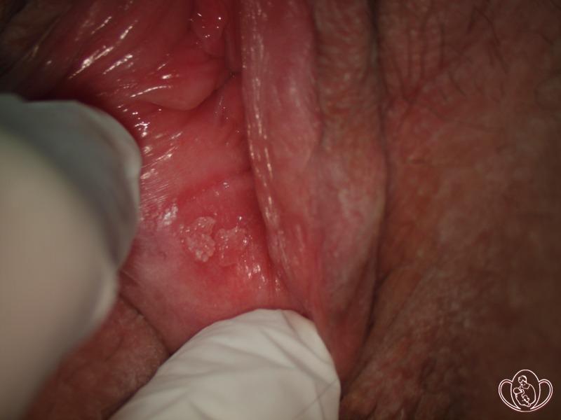 Герпетические высыпания на правой малой половой губе в стадии разрешения (в виде корочки)